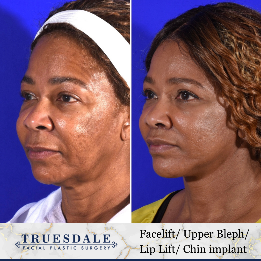 Deep Plane Facelift Truesdale Facial Plastic Surgery Before and After Gallery
