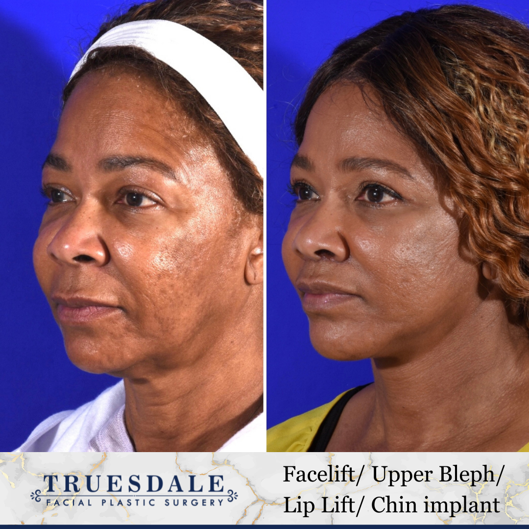 Truesdale Facial Plastic Surgery Before and After Gallery