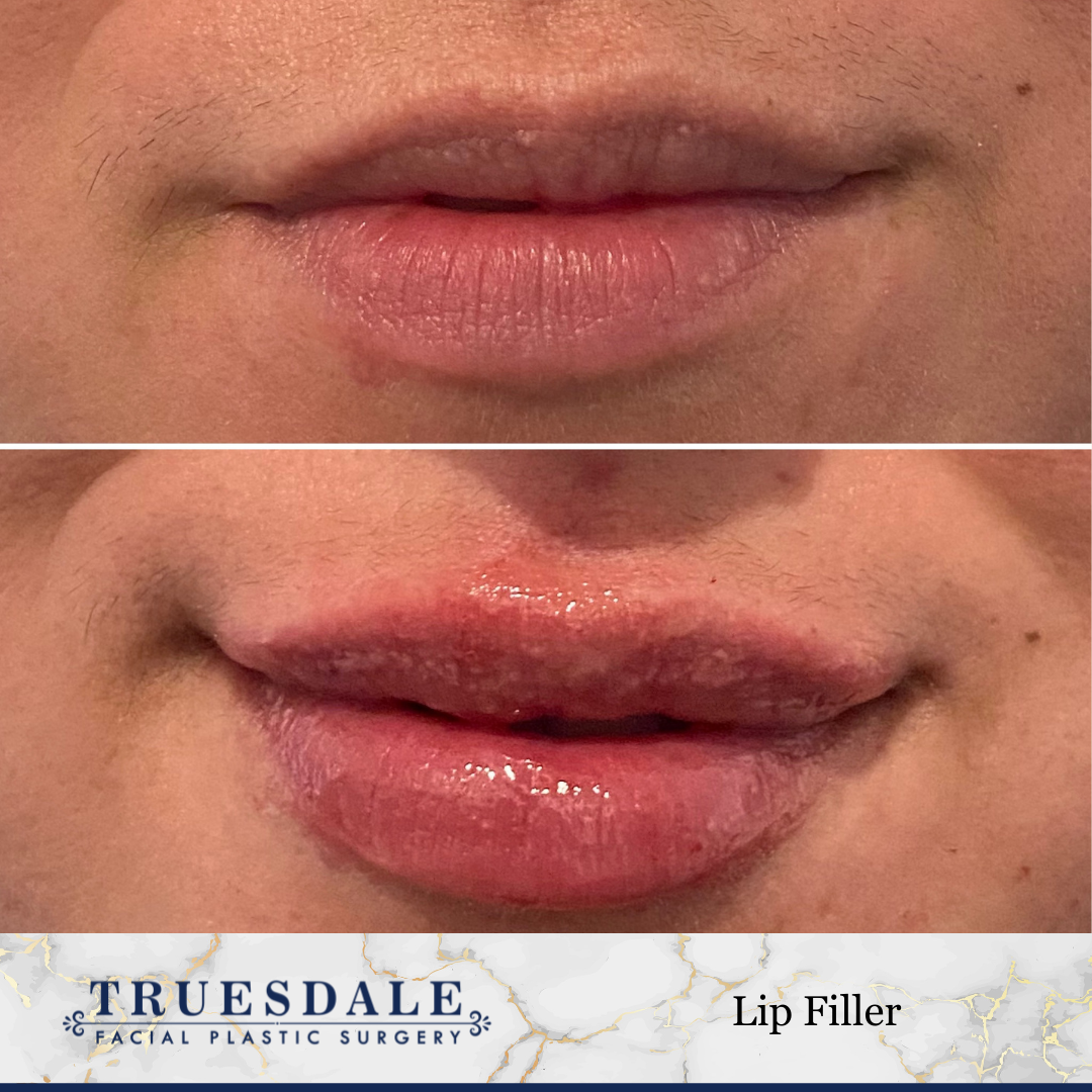 Truesdale Facial Plastic Surgery Before and After Gallery