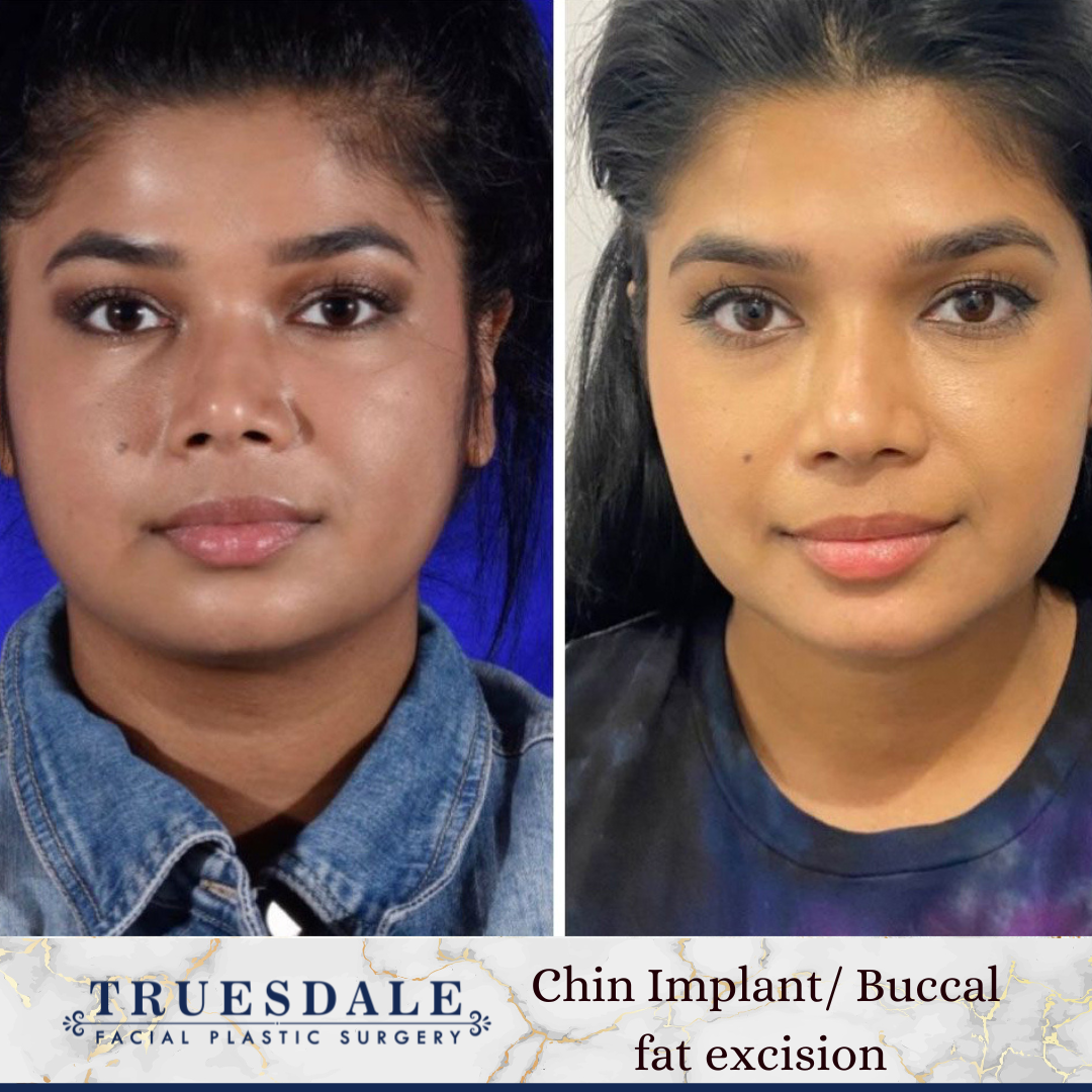 Truesdale Facial Plastic Surgery Before and After Gallery