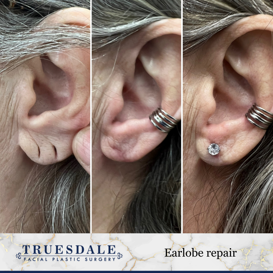 Earlobe Repair: Restore Your Ears with Dr. Lopes - Cosmetic Surgery Center