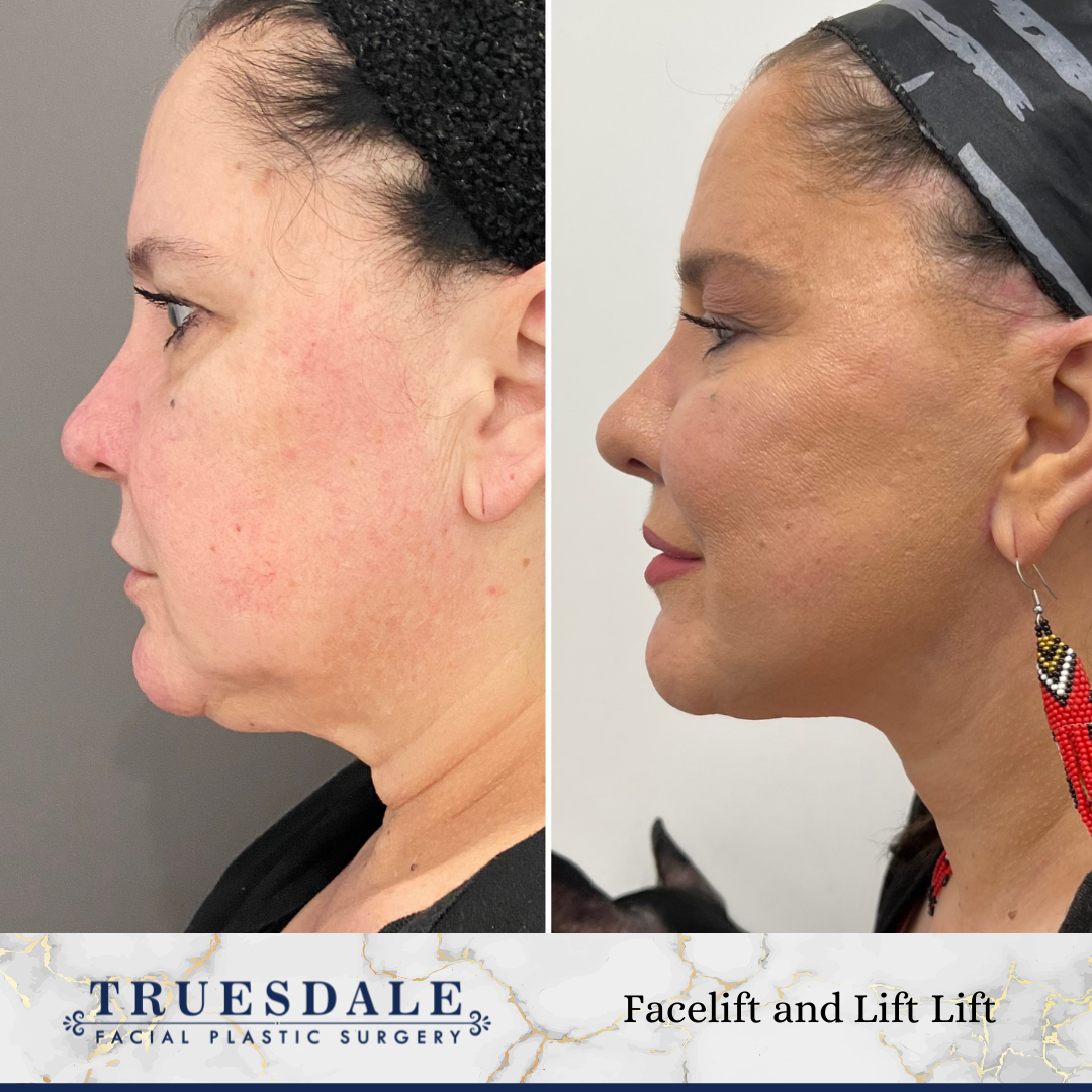 Truesdale Facial Plastic Surgery Before and After Gallery