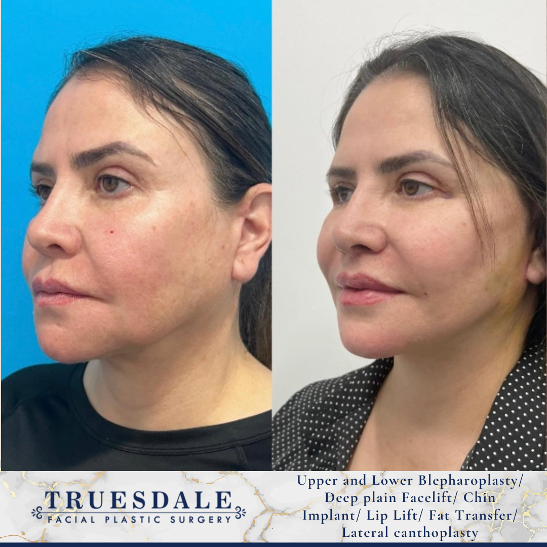 Lip Lift Truesdale Facial Plastic Surgery Before and After Gallery