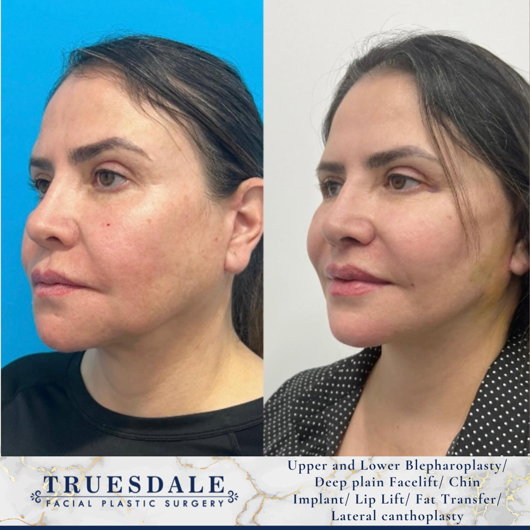 Truesdale Facial Plastic Surgery Before and After Gallery