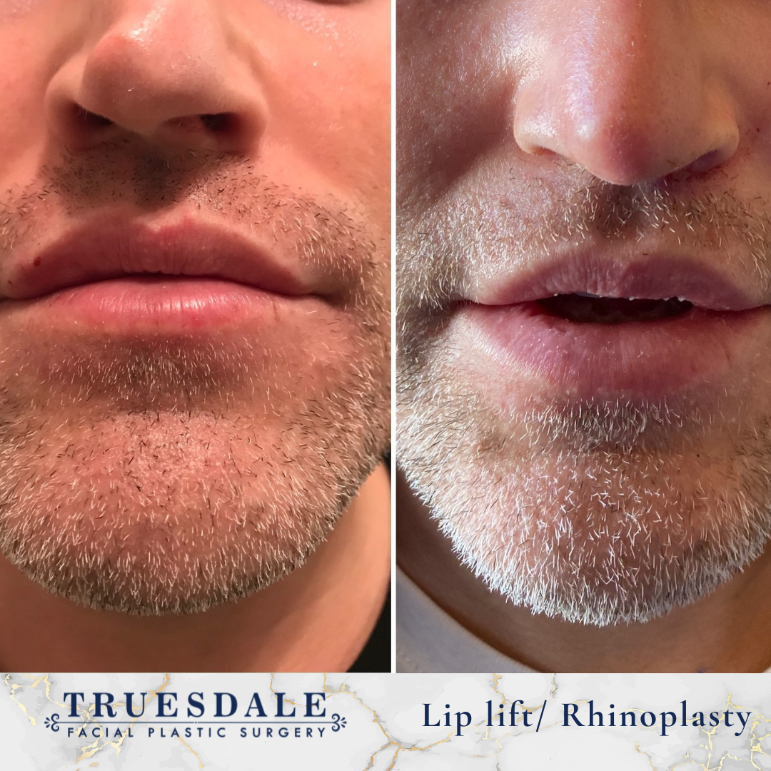 Lip Lift Truesdale Facial Plastic Surgery Before and After Gallery