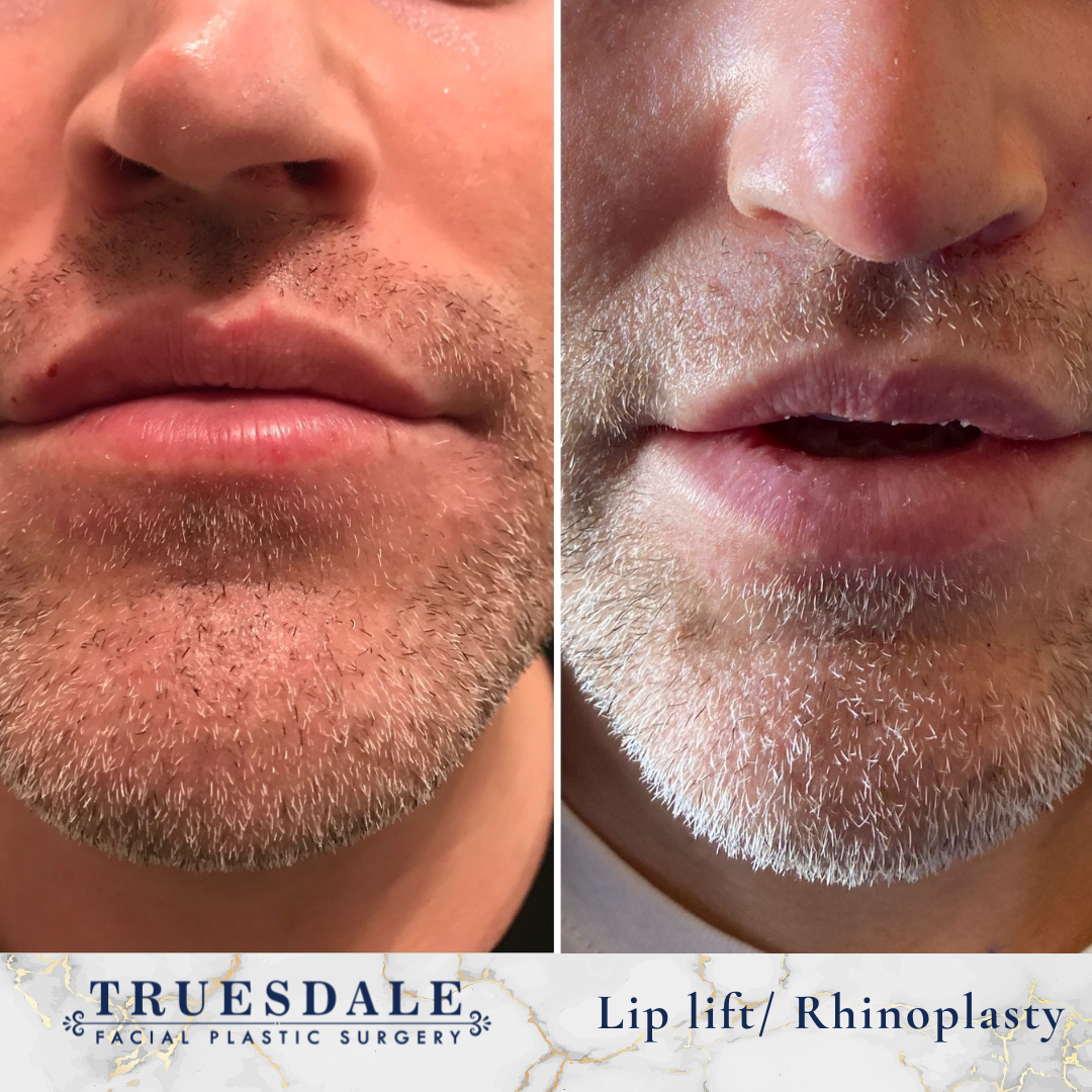 Truesdale Facial Plastic Surgery Before and After Gallery