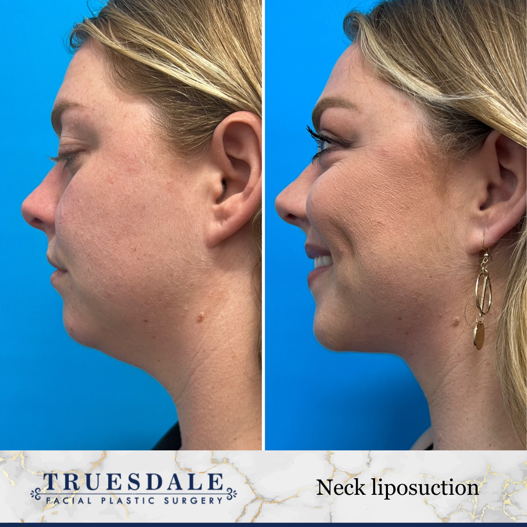 Truesdale Facial Plastic Surgery Before and After Gallery