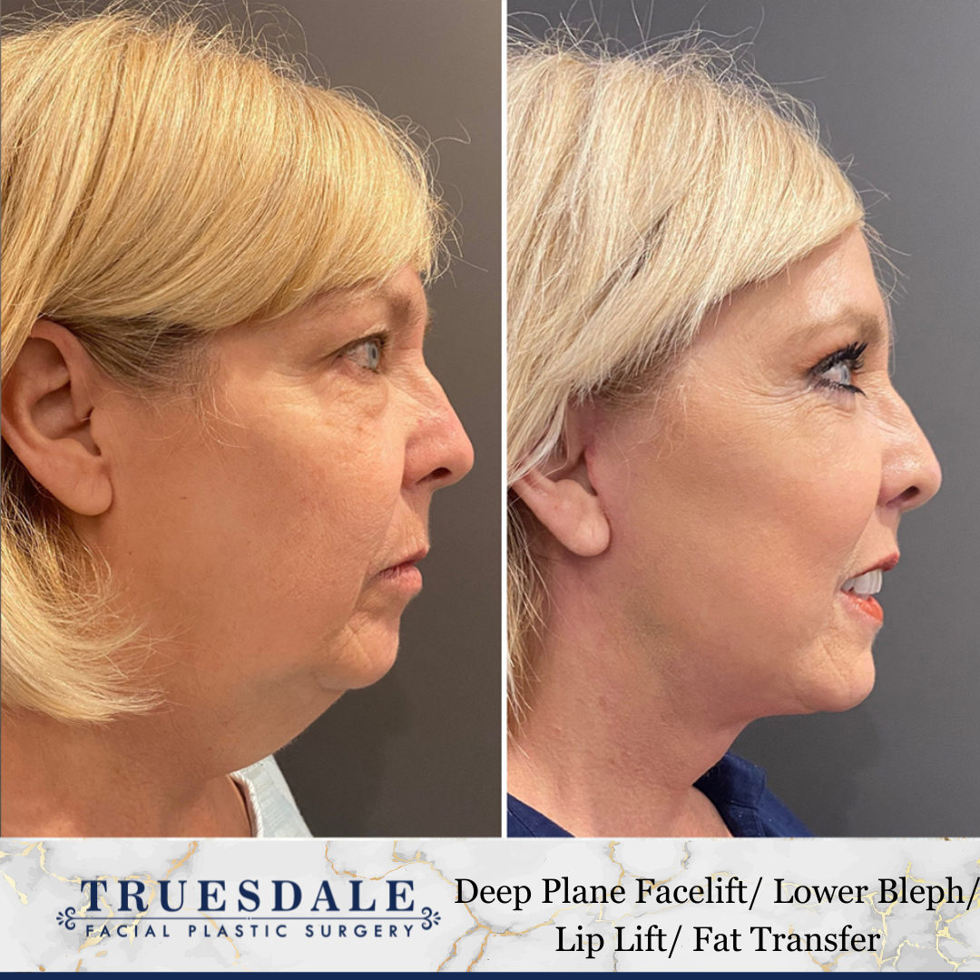 Facelift Beverly Hills  Truesdale Facial Plastic Surgery