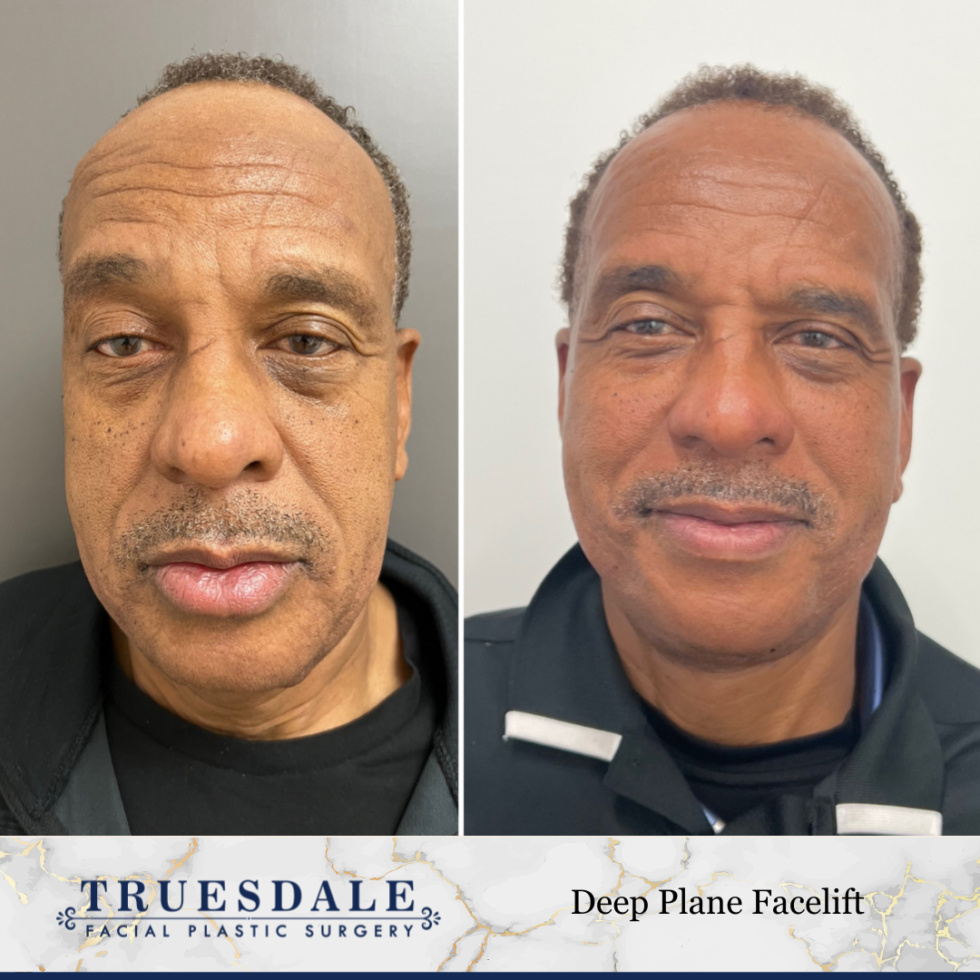 Facelift Beverly Hills Truesdale Facial Plastic Surgery