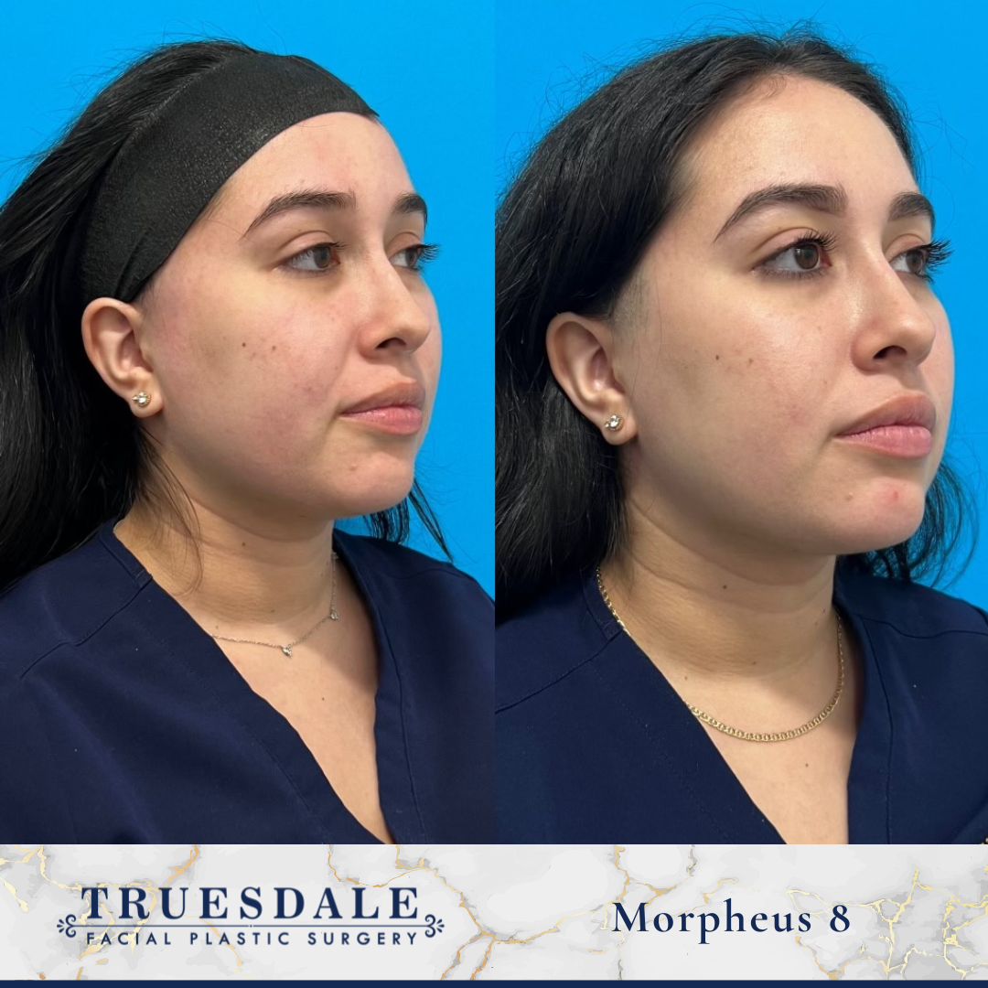 Facelifts - Before and After (12)