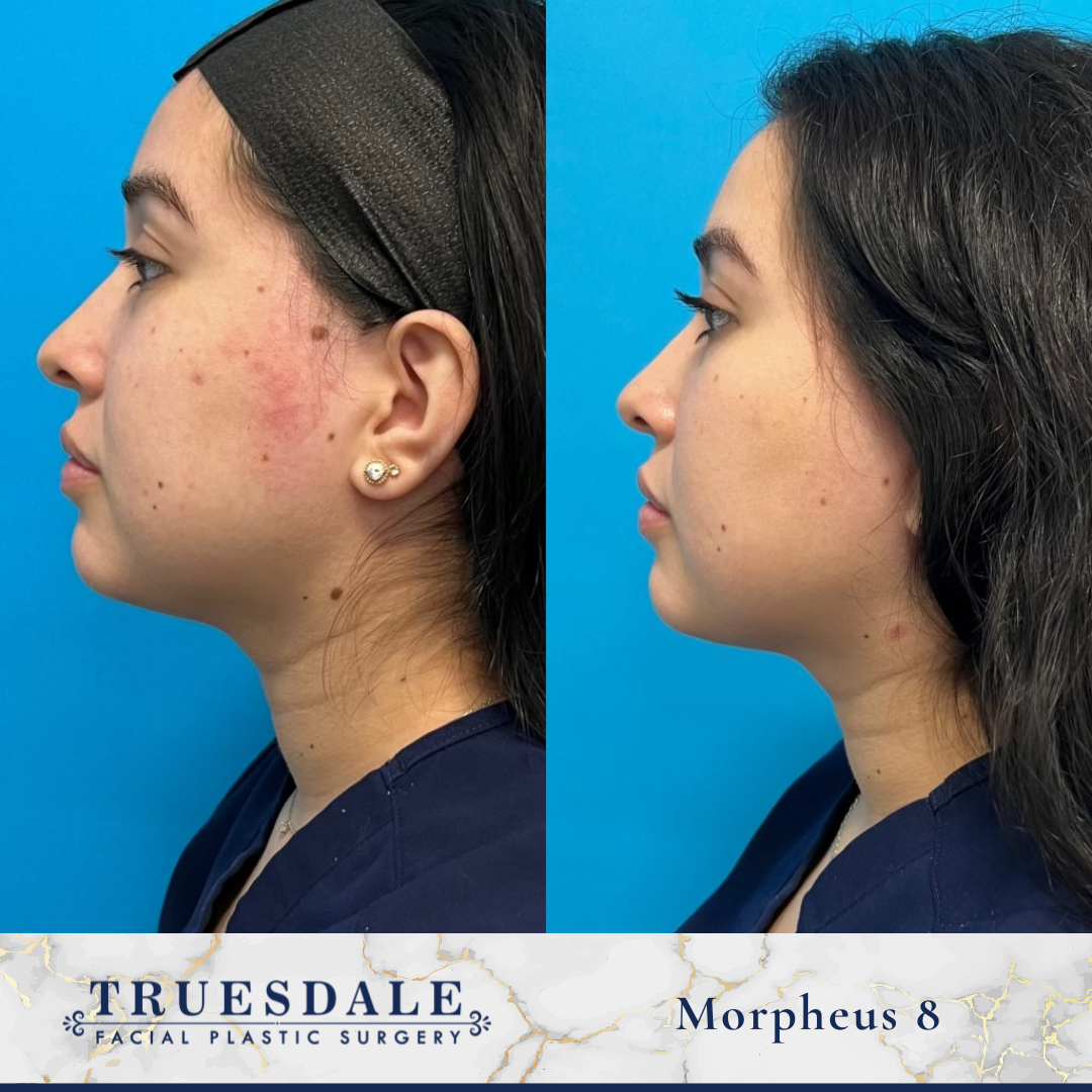 Facelifts - Before and After (13)