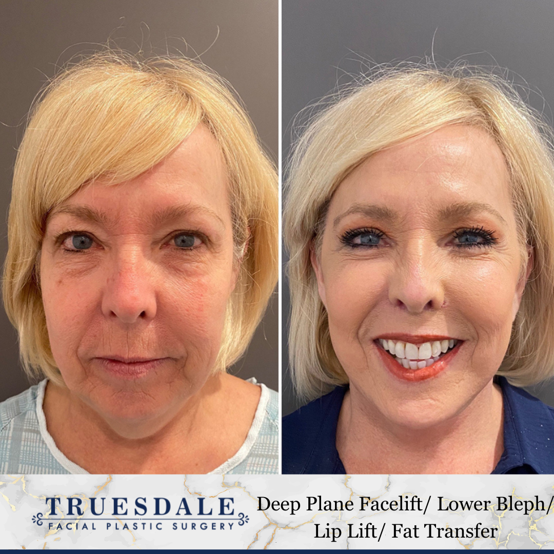 Facial Fat Transfer (4)