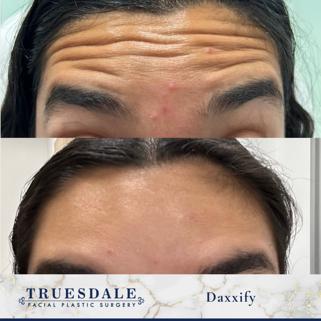 Wrinkle Treatment Before and After Pictures Beverly Hills, CA