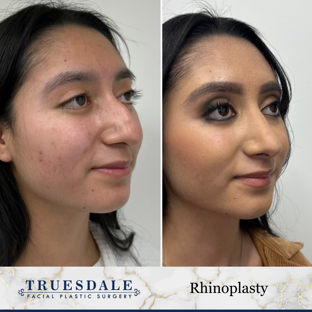 Rhinoplasty & Alarplasty Before and After Pictures Beverly Hills, CA