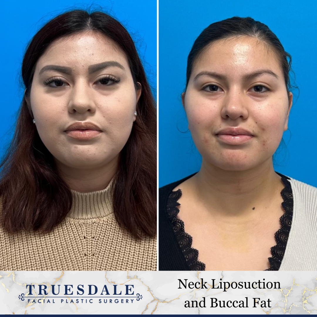 Neck (Submental) Liposuction Before and After Pictures Beverly Hills, CA