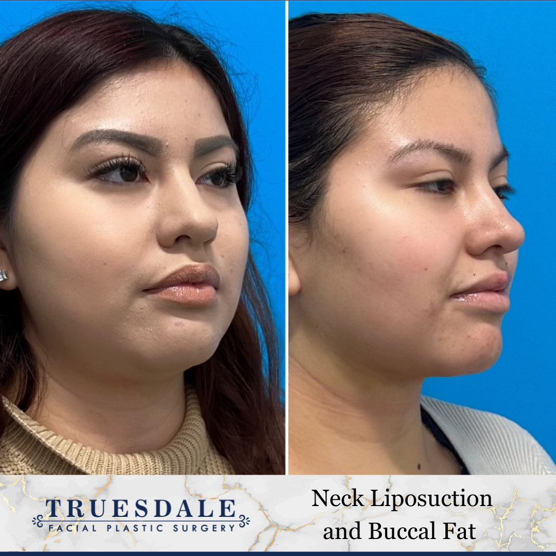 Buccal Fat Removal Before and After Pictures Beverly Hills, CA