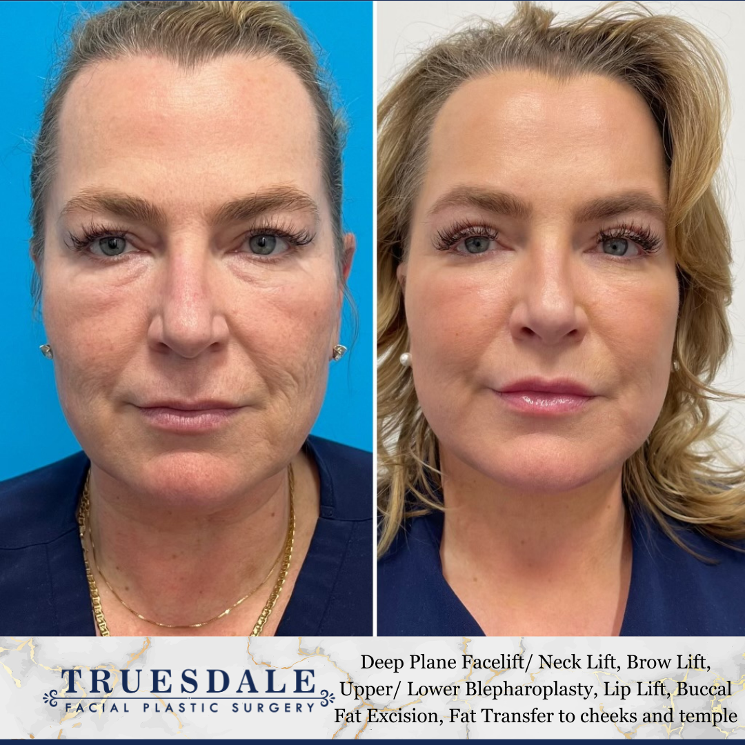 Facelift Before and After Pictures Beverly Hills, CA