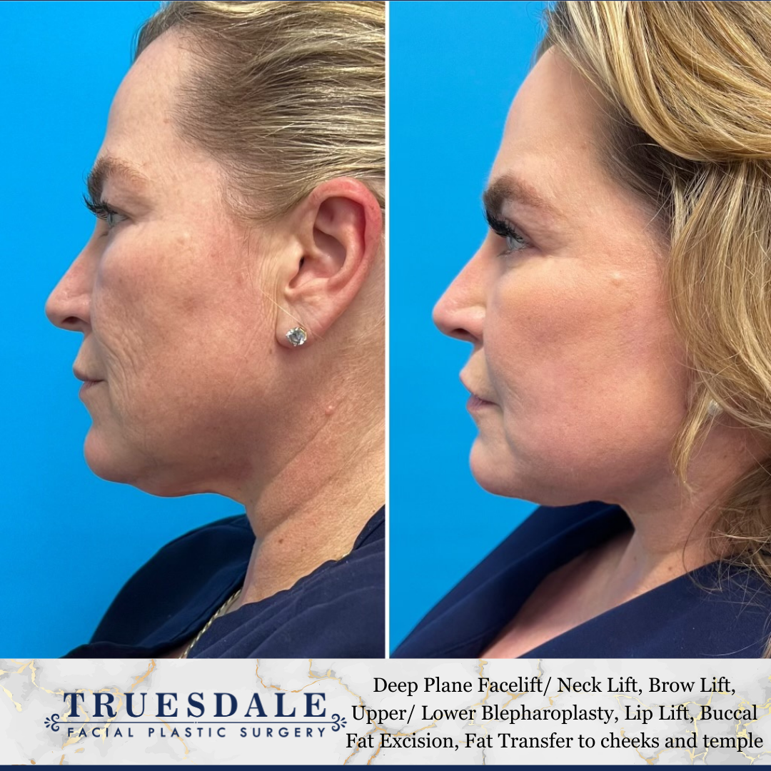 Facelift Before and After Pictures Beverly Hills, CA