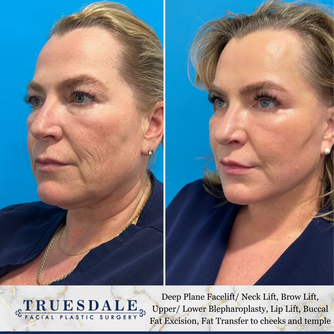 Facelift Before and After Pictures Beverly Hills, CA