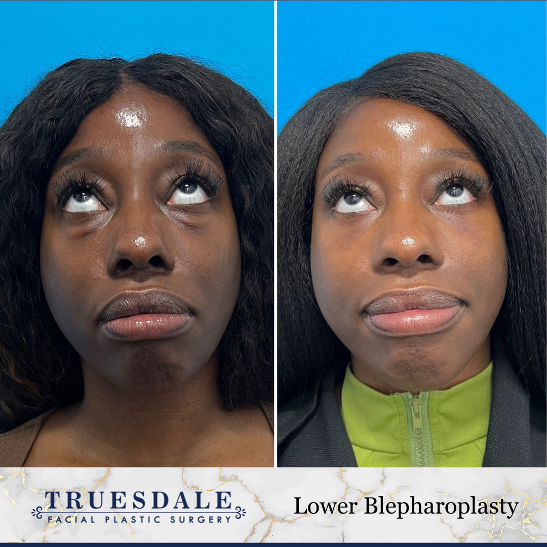 Eyelid & Undereye Surgery (Blepharoplasty) Before and After Pictures Beverly Hills, CA