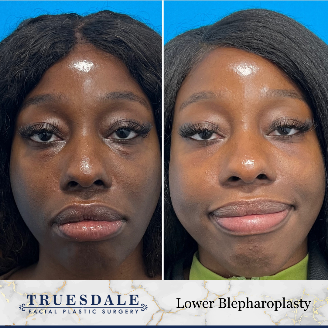Eyelid & Undereye Surgery (Blepharoplasty) Before and After Pictures Beverly Hills, CA