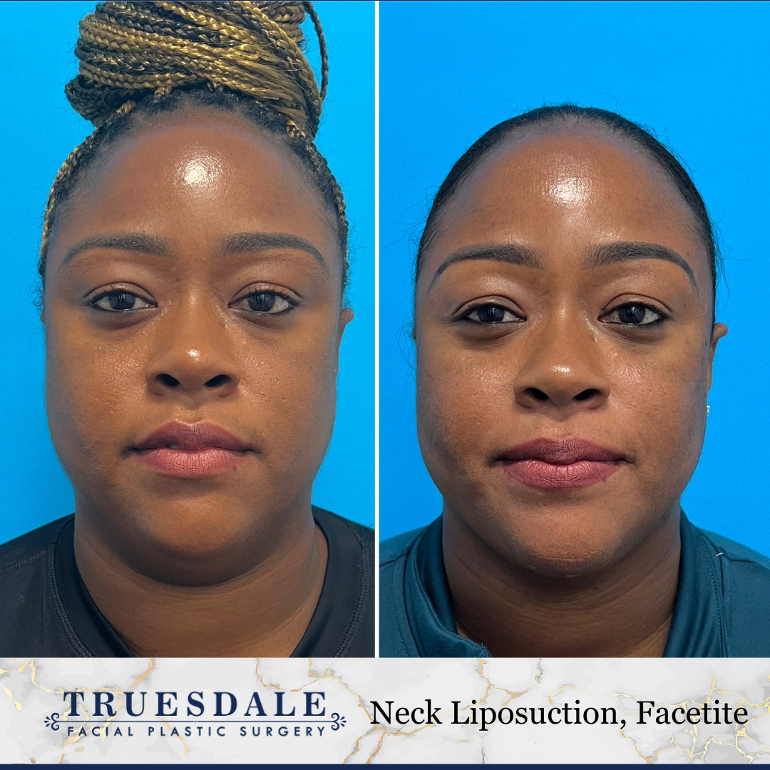 Neck (Submental) Liposuction Before and After Pictures Beverly Hills, CA