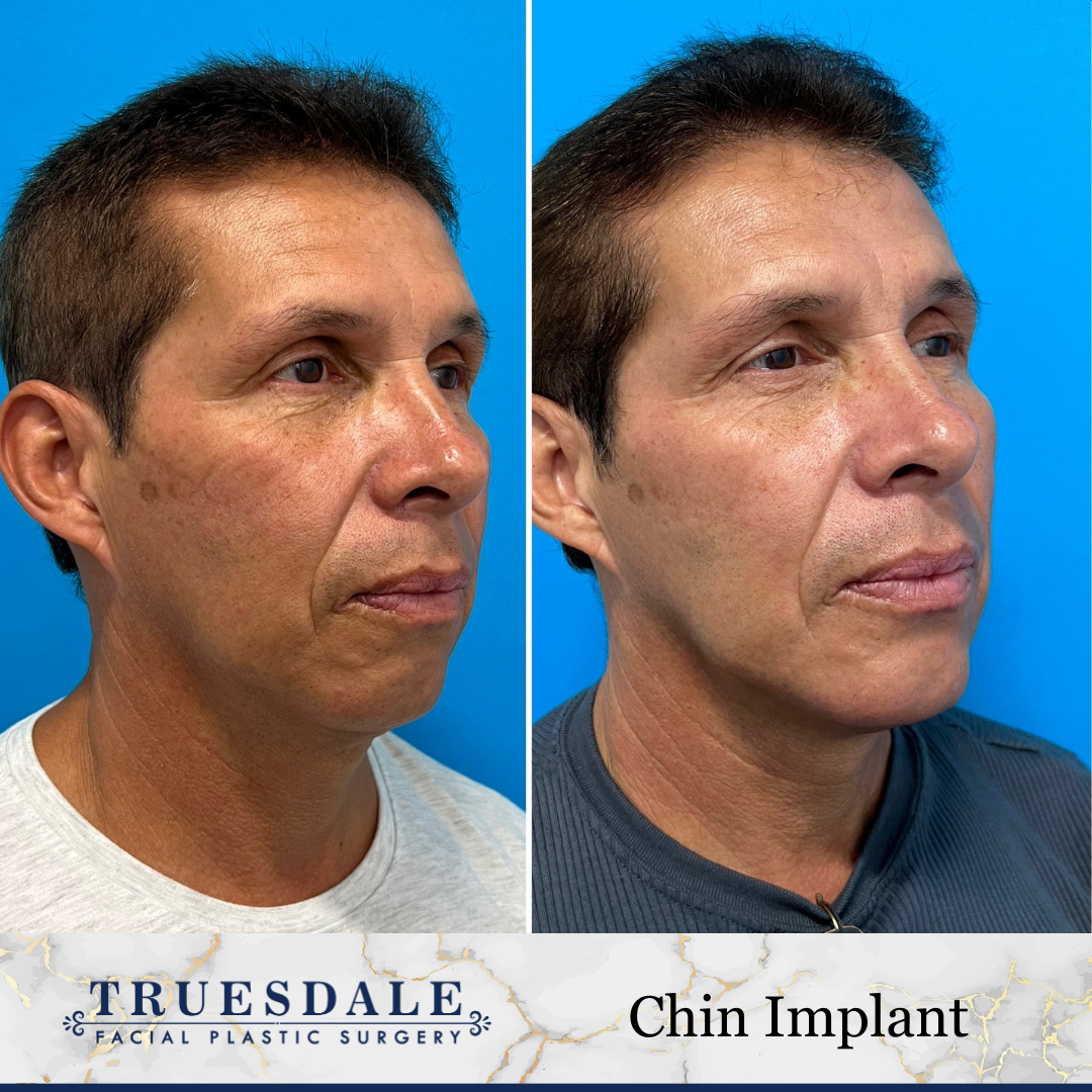 Chin Augmentation Before and After Pictures Beverly Hills, CA