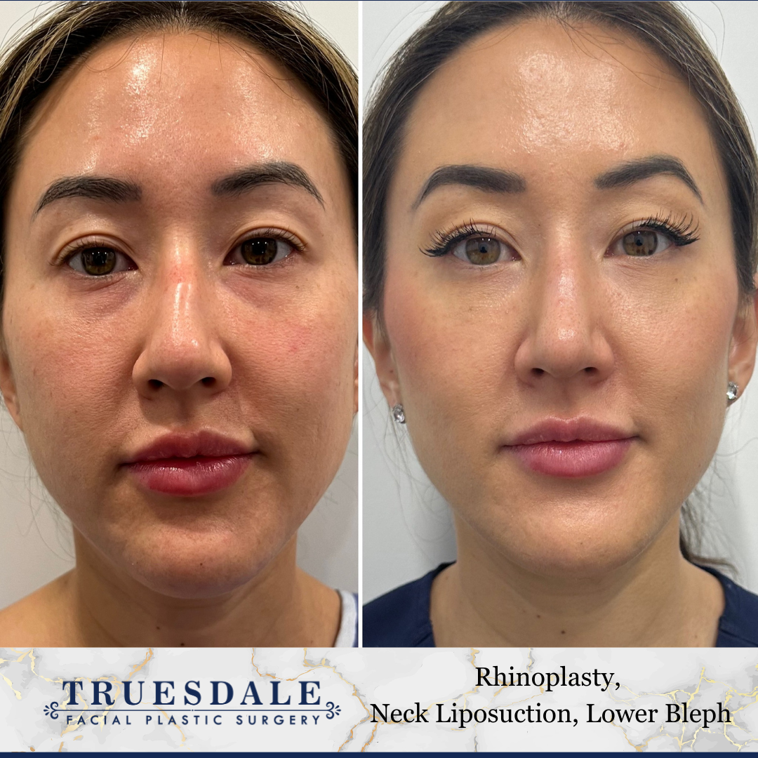 Rhinoplasty & Alarplasty Before and After Pictures Beverly Hills, CA