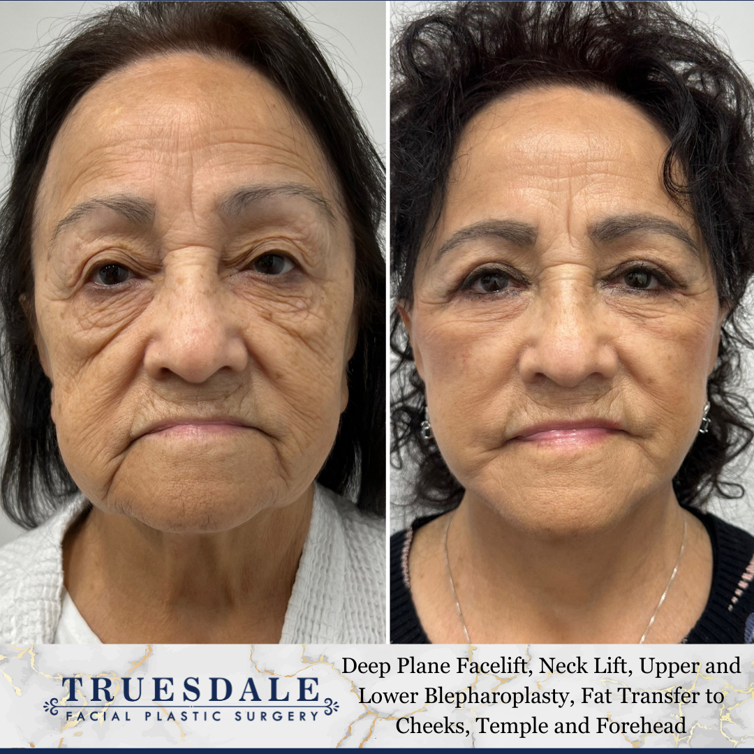 Facelift Before and After Pictures Beverly Hills, CA