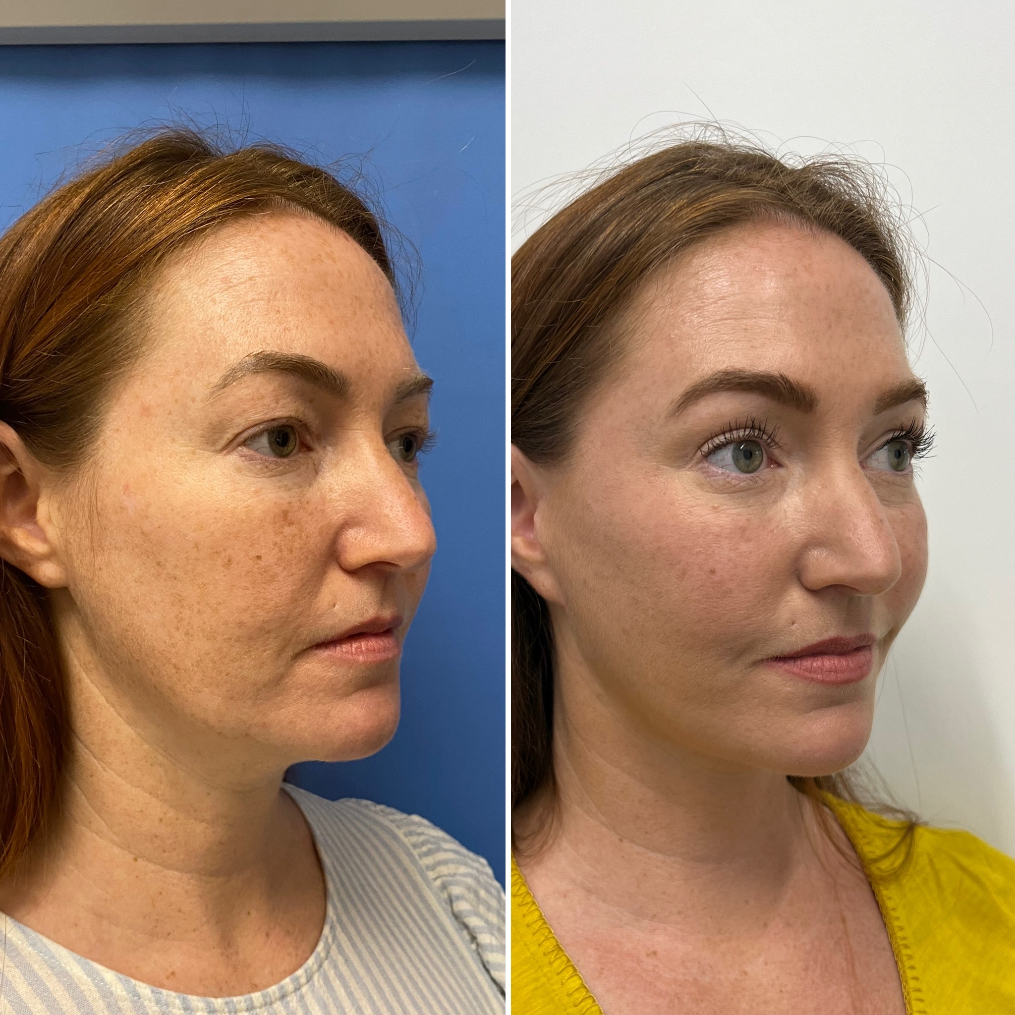 Example of facelift patient in her 50s