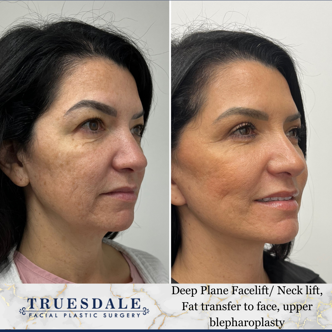 150 Example of facelift patient in her 50s
