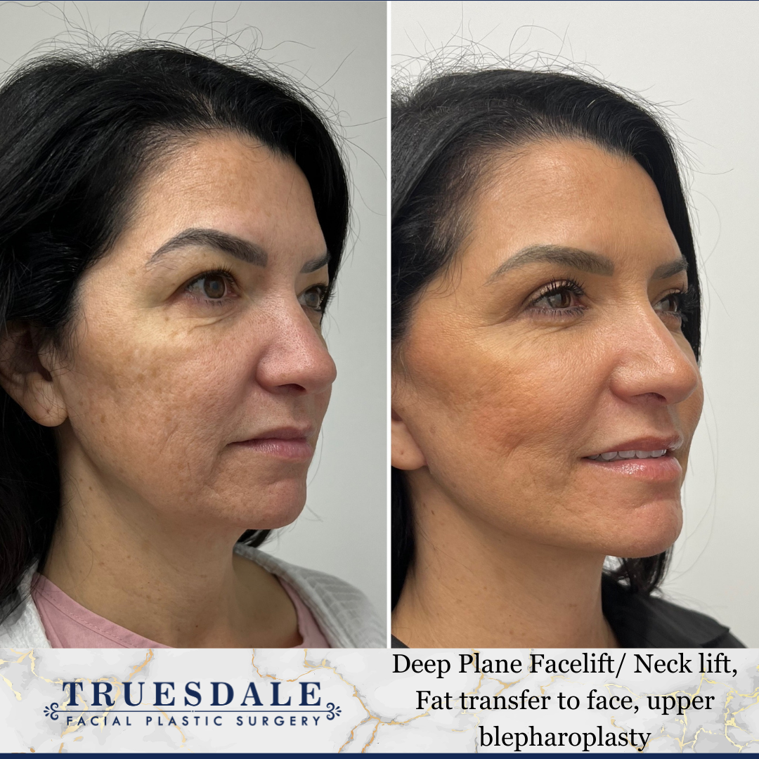 Example of facelift patient in her 50s