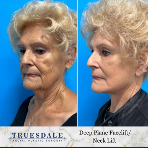 Example of facelift patient in her 50s