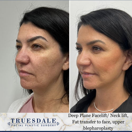 18 Example of facelift patient in her 50s