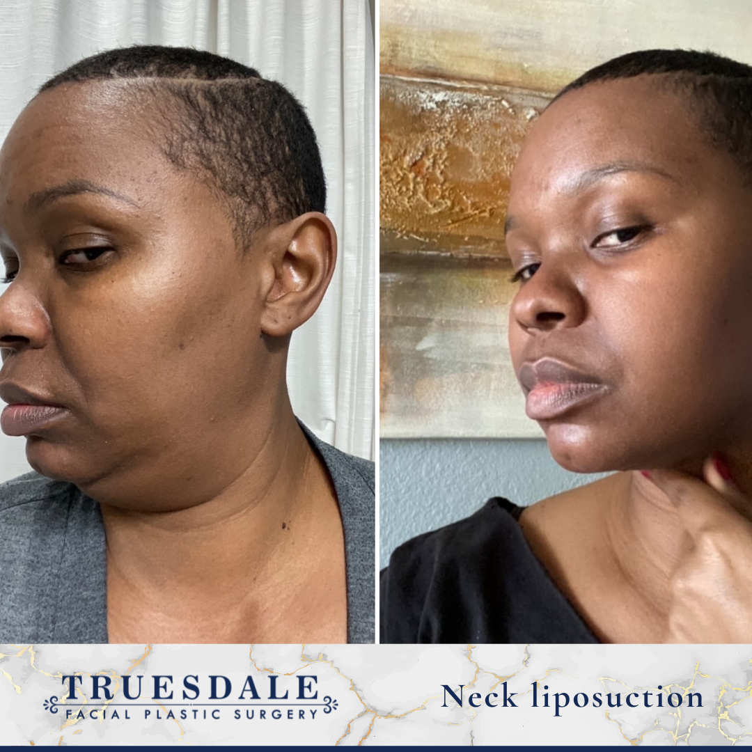 Facelift Before and After Pictures Beverly Hills, CA