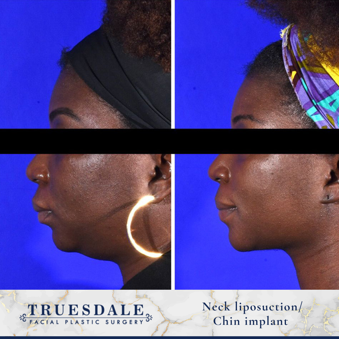 Facelift Before and After Pictures Beverly Hills, CA