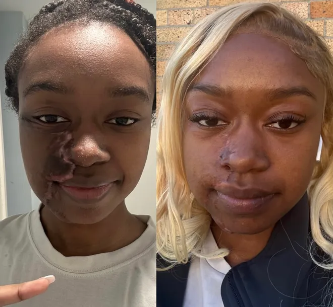 A random woman threw acid in her face; 18 months later, scars fade as impact lingers