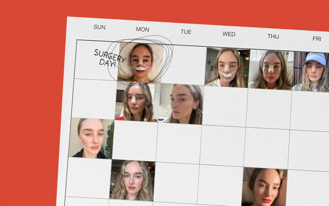 After Years of Daydreaming, I Finally Got a Nose Job at 34
